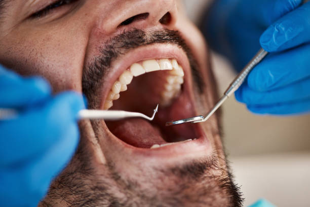 Best Emergency Dental Care for Broken or Chipped Teeth in New Hampton, IA